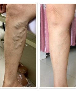 Máy nén ép trị liệu suy giãn tĩnh mạch Kachi MK394