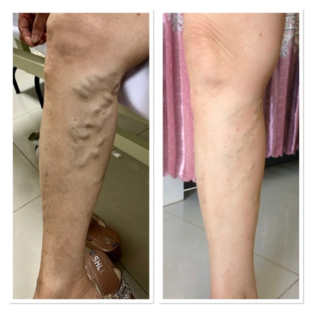 Máy nén ép trị liệu suy giãn tĩnh mạch Kachi MK394