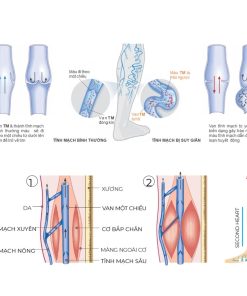 Tất trị liệu giãn tĩnh mạch Sankom Thuỵ Sĩ